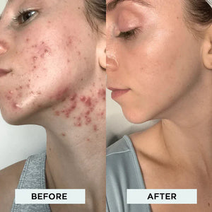 DermaGlow - High Frequency Skin Therapy Wand