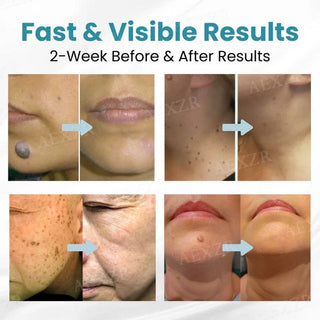 ClearDerm – Precision Laser Pen